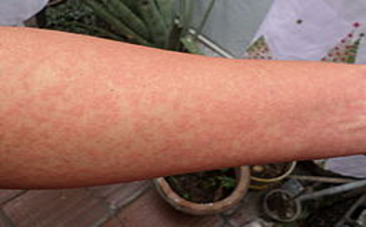 Casos de chikungunya crescem quase 2.900% no estado de SP